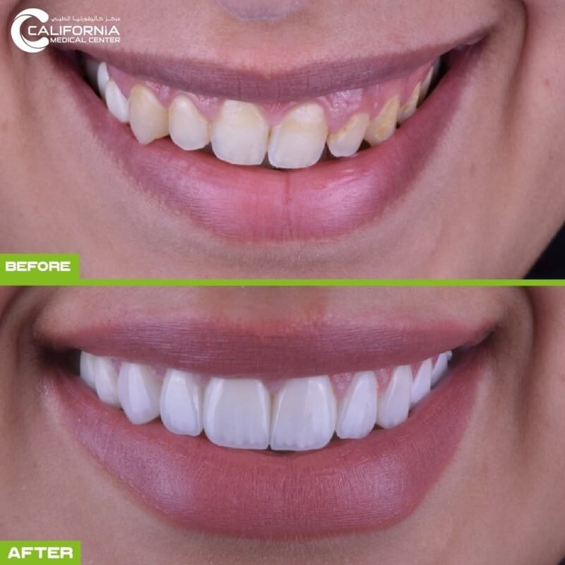 2. California Smile After Before (1)