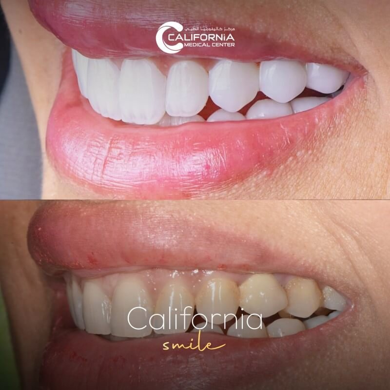 3. California Smile After Before (1)