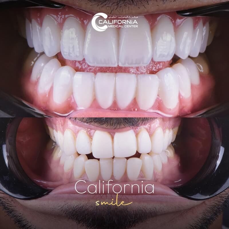 5. California Smile After Before (1)